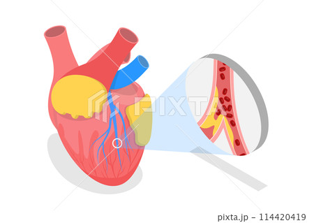 3D Isometric Flat  Conceptual Illustration of Myocardial Infarction, Heart Attack 114420419