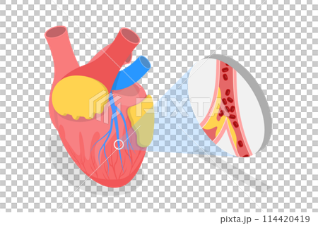 3D Isometric Flat  Conceptual Illustration of Myocardial Infarction, Heart Attack 114420419