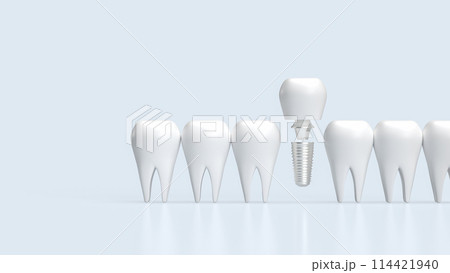 The dental implants for health and medical concept 3d rendering. 114421940