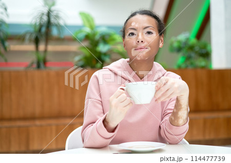 Black african american woman with vitiligo Black african american woman with vitiligo 114477739