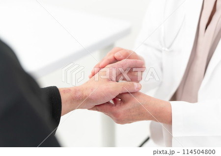 医療 アトピー性皮膚炎 手元 医療 アトピー性皮膚炎 手元 114504800