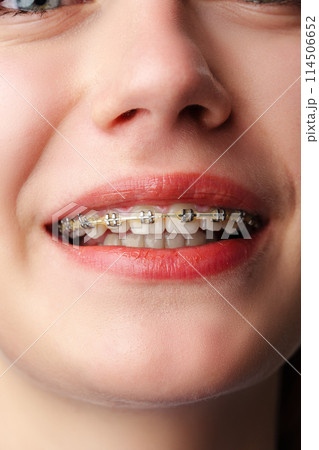 Young woman with dental braces close up 114506652