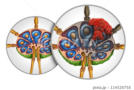 Lymphoma Lymph Node Cancer 114520758