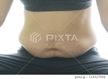 産後の妊娠線が残る女性のお腹のアップ 産後の妊娠線が残る女性のお腹のアップ 114527009