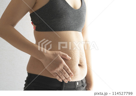 産後の妊娠線が残る女性のお腹のアップ 産後の妊娠線が残る女性のお腹のアップ 114527799