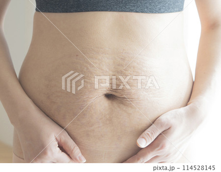 産後の妊娠線が残る女性のお腹のアップ 114528145