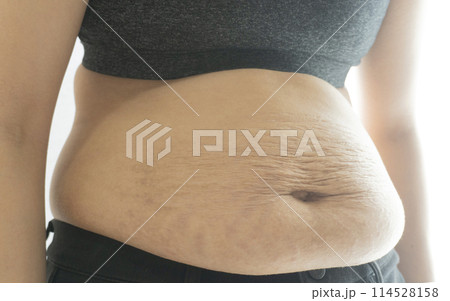産後の妊娠線が残る女性のお腹のアップ 産後の妊娠線が残る女性のお腹のアップ 114528158