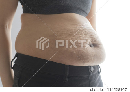 産後の妊娠線が残る女性のお腹のアップ 114528167