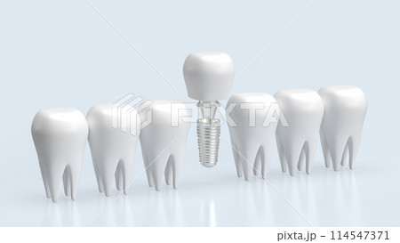 The dental implants for health and medical concept 3d rendering. 114547371
