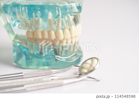 Dental implant, artificial tooth roots into jaw, root canal of dental treatment, gum disease, teeth model for dentist studying about dentistry. Dental implant, artificial tooth roots into jaw, root canal of dental treatment, gum disease, teeth model for dentist studying about dentistry. 114548590