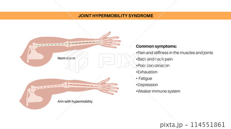 Joint hypermobility poster Joint hypermobility poster 114551861
