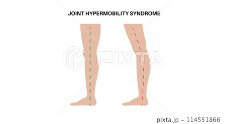 Joint hypermobility poster Joint hypermobility poster 114551866