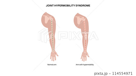 Joint hypermobility poster 114554971