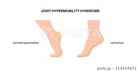 Joint hypermobility poster 114554972