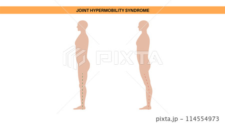 Joint hypermobility poster 114554973