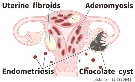 子宮筋腫・子宮腺筋症・子宮内膜症の合併　わかりやすい英語図解イラスト 114559641