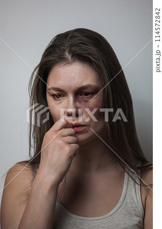 Domestic violence, abuse woman with bruise on face 114572842