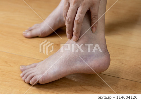 ねん挫した女性の足首 ねん挫した女性の足首 114604120