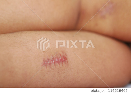 Stitched wound mark on a child foot. Stitched wound mark on a child foot. 114616465