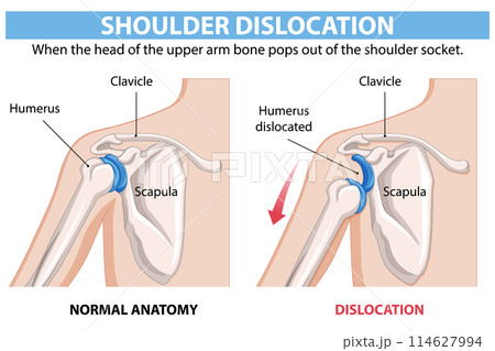 Shoulder Dislocation Anatomy Illustration 114627994