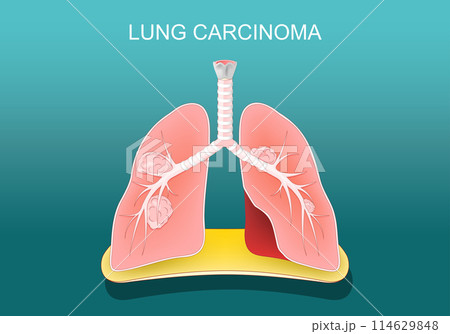 Lung carcinoma. Cancer. Tumors metastasize, 114629848