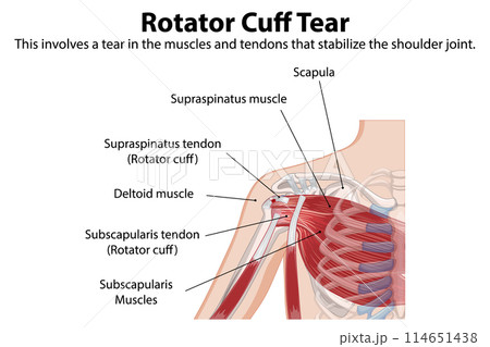 Rotator Cuff Tear Illustration 114651438