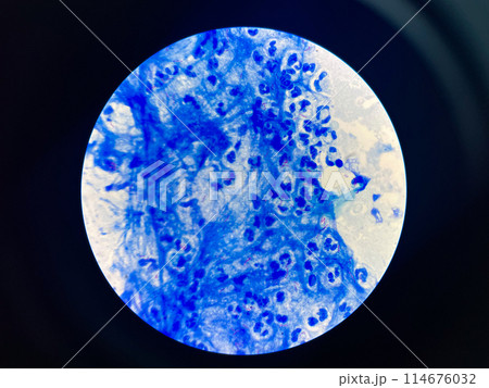 AFB 3+ sample collect sputum. AFB 3+ sample collect sputum. 114676032