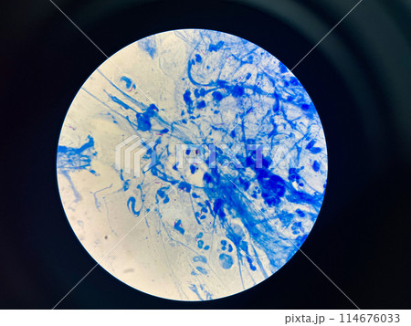 AFB 3+ sample collect sputum. AFB 3+ sample collect sputum. 114676033