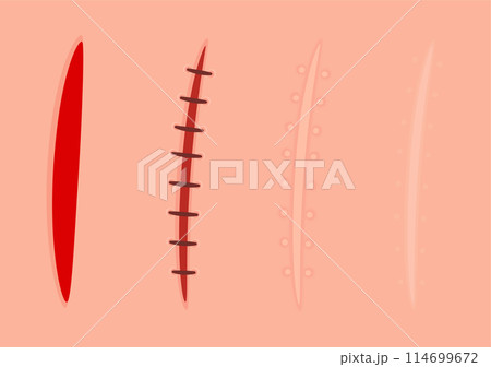 Skin scar healing process 114699672