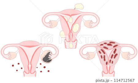 子宮筋腫・子宮腺筋症・子宮内膜症の比較 わかりやすい図解イラスト 子宮筋腫・子宮腺筋症・子宮内膜症の比較 わかりやすい図解イラスト 114712567