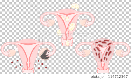 子宮筋腫・子宮腺筋症・子宮内膜症の比較 わかりやすい図解イラスト 子宮筋腫・子宮腺筋症・子宮内膜症の比較 わかりやすい図解イラスト 114712567