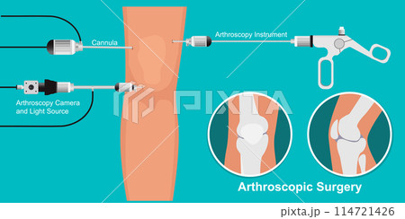 Arthroscopy medical treatment surgery. 114721426
