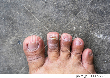 Nail falls off 114727232