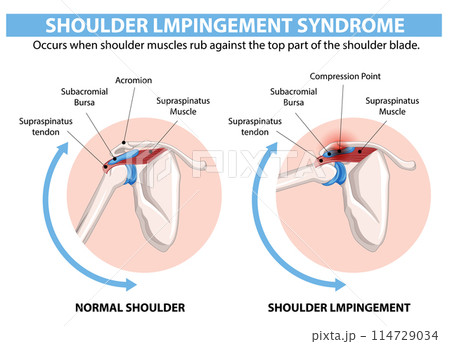 Shoulder Impingement Syndrome Illustration 114729034