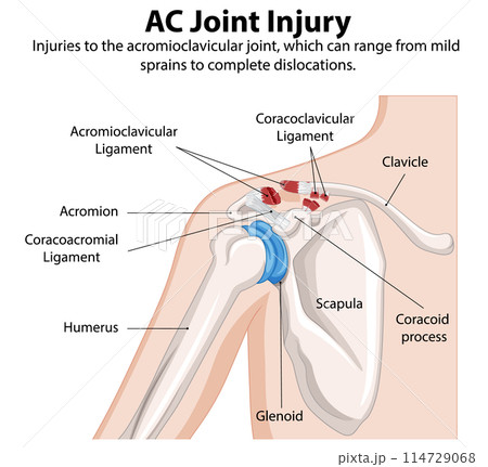 AC Joint Injury Diagram 114729068