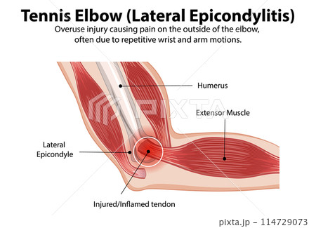 Tennis Elbow Anatomy Illustration 114729073