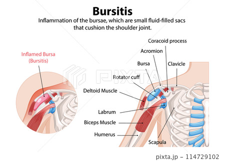 Bursitis in the Shoulder Joint 114729102