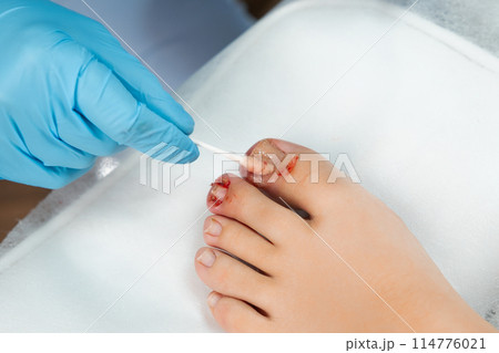 Close up podologist treats the nail with an antifungal agent.  114776021