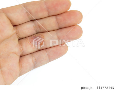 左手の薬指にできた手湿疹 左手の薬指にできた手湿疹 114778143