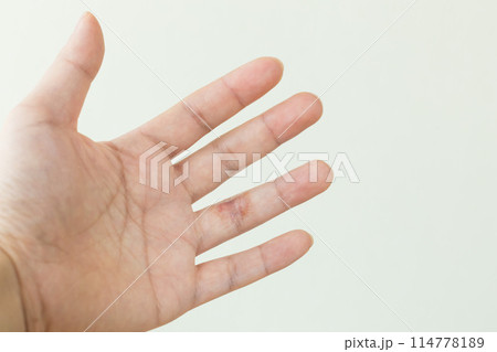 薬指にできた手湿疹 114778189