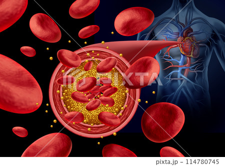 atherosclerosis Artery Plaque 114780745