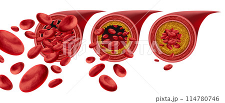 Atherosclerosis Plaque Formation 114780746