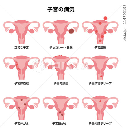 2024人体-子宮の病気イラスト 114793198