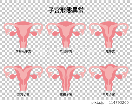 2024人體-子宮形態異常圖 114793200