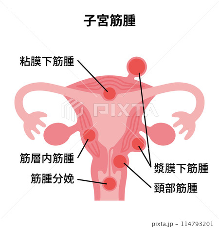 2024人体-子宮筋腫イラスト 114793201