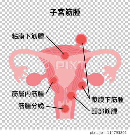 2024 人體-子宮肌瘤圖 114793201