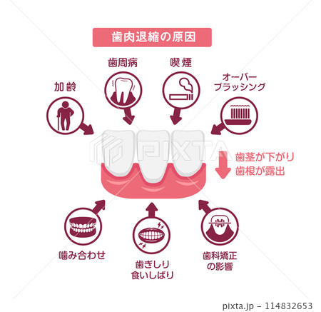 歯肉退縮（歯茎の下がり）の原因 ベクターイラスト 114832653