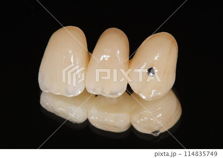 歯医者さんで綺麗なセラミックの歯に直そう 114835749