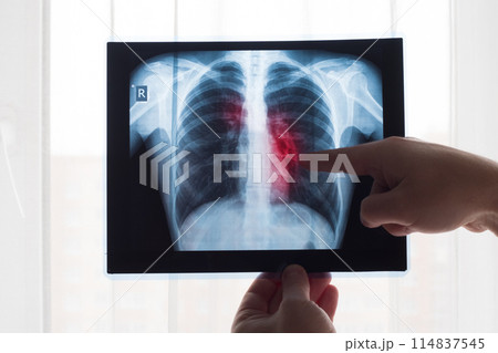 Lung radiography concept. Radiology doctor examining at chest x ray film of patient Lung Cancer or Pneumonia. Virus and bacteria infected the Human lungs. Patient with Lung Cancer or Pneumonia 114837545