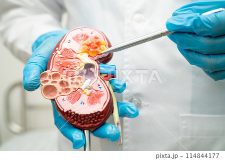 Kidney disease, Chronic kidney disease ckd, Doctor with human model to study and treat in hospital. 114844177